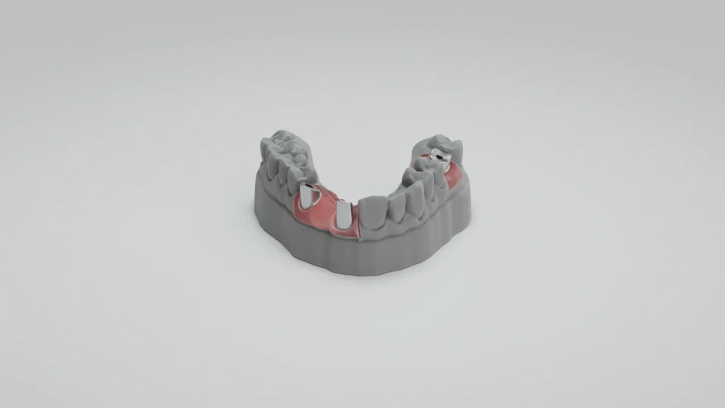 Model pro implantáty s gingivální maskou z materiálu Model GP