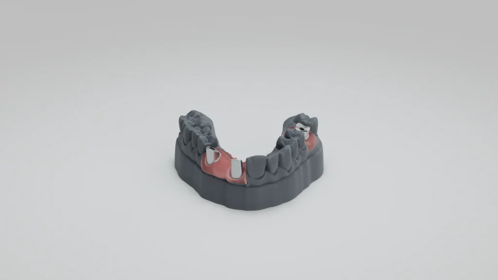 Model pro implantáty s gingivální maskou z materiálu Model WW